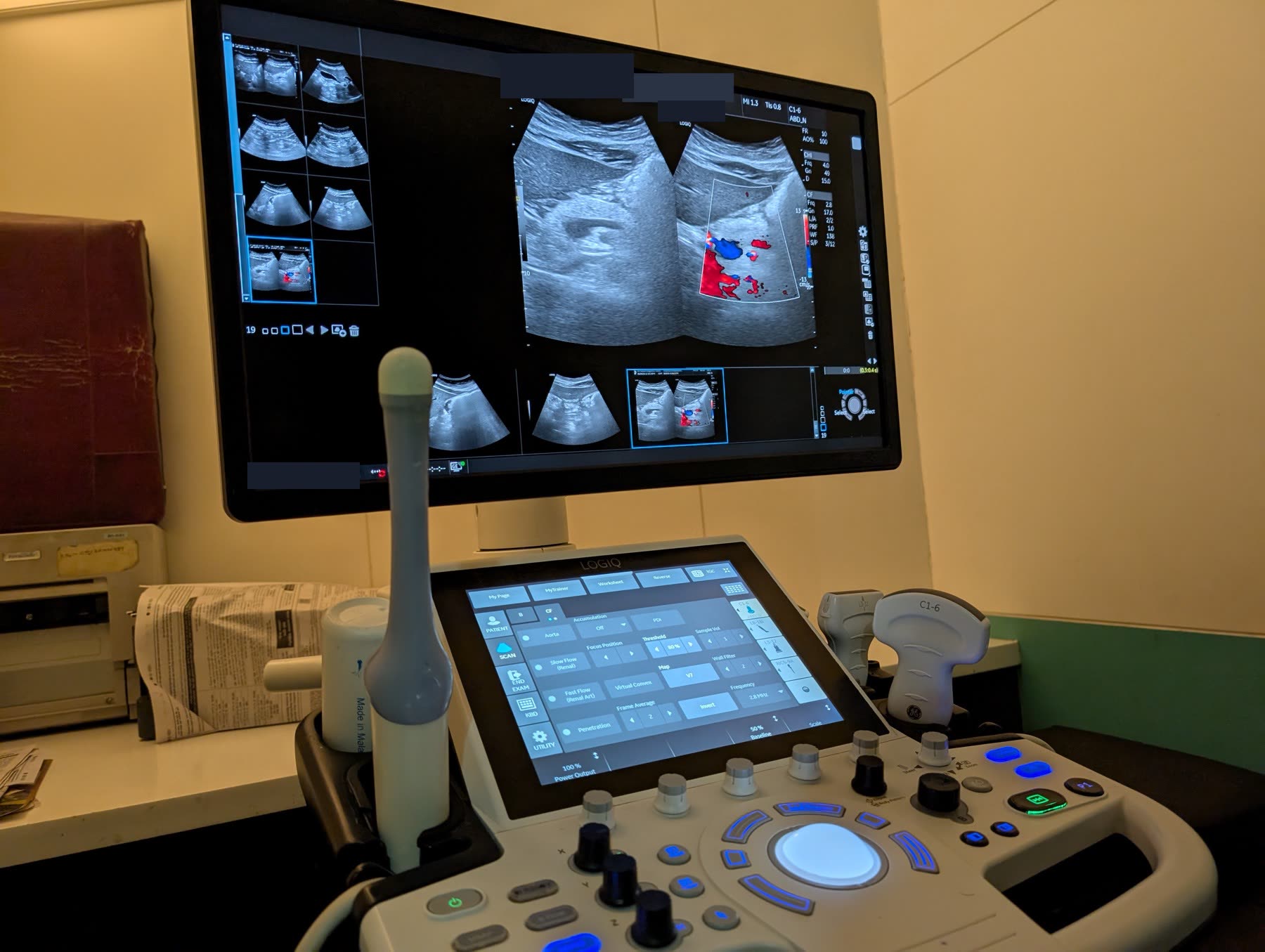 A Colour Doppler study on the ultrasound system at the centre