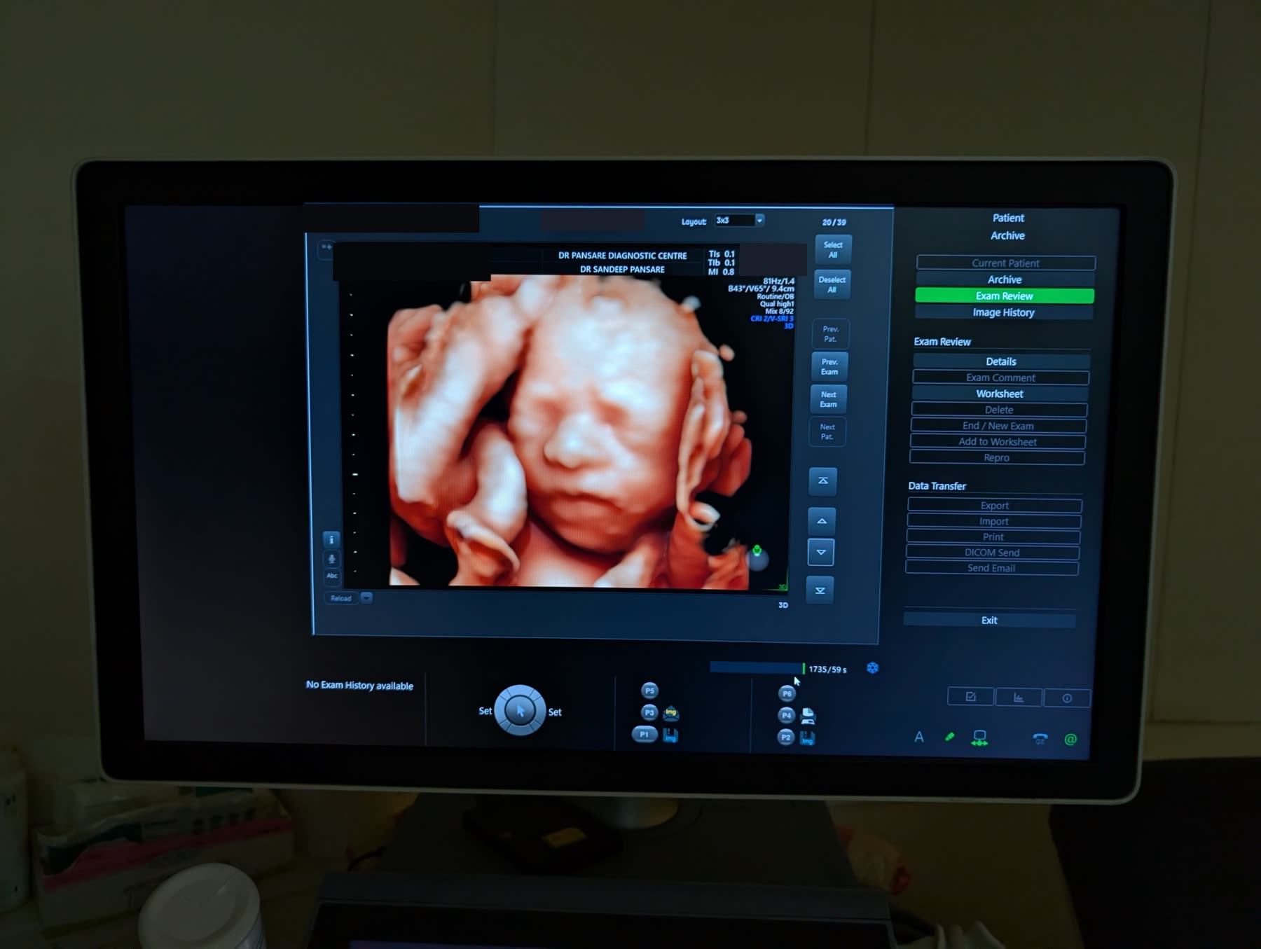 A three-dimensional ultrasound image of a baby on the scanner at the centre